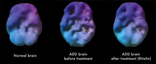 A brain scan of 3 different brains
1st: Normal functioning, smooth.
2nd: ADD brain before treatment, divots/holes in the brain, two most prominent in the frontal cortex.
3rd: ADD brain after treatment (Ritalin). Looks smoother, less exaggerated divots.