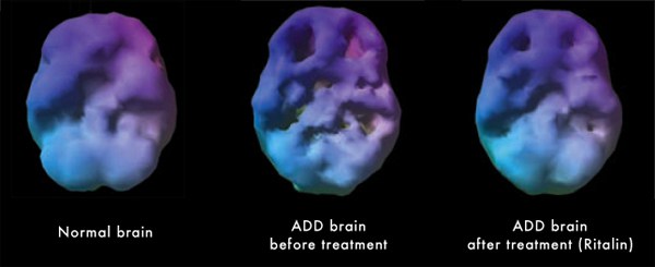 A brain scan of 3 different brains
1st: Normal functioning, smooth.
2nd: ADD brain before treatment, divots/holes in the brain, two most prominent in the frontal cortex.
3rd: ADD brain after treatment (Ritalin). Looks smoother, less exaggerated divots.
